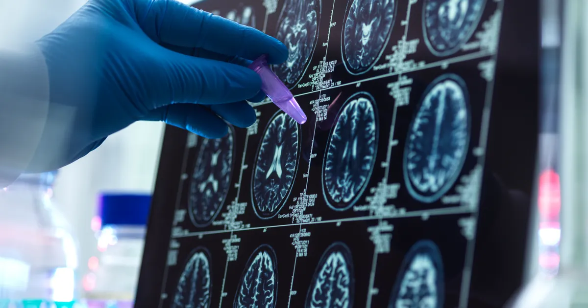Cegah Stroke Sejak Dini, Hindari 7 Kebiasaan Ini Setelah Jam 5 Sore